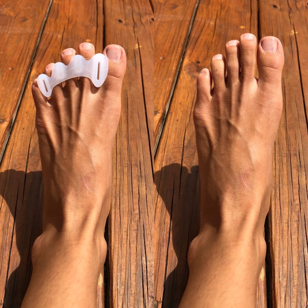 Correct Toes Review - Are They Worth It?