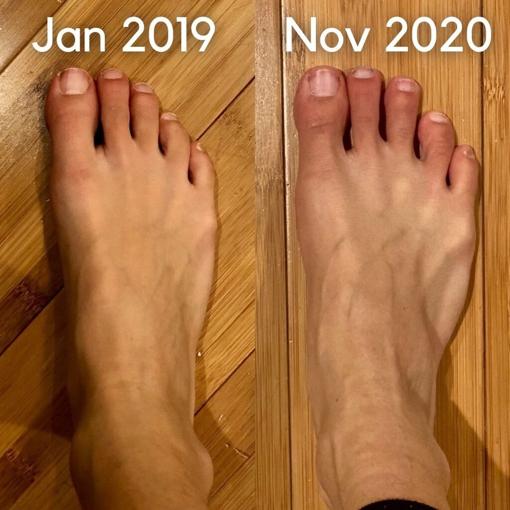 Longing Complexity Unevenness Benefits Of Barefoot Shoes Citabeille