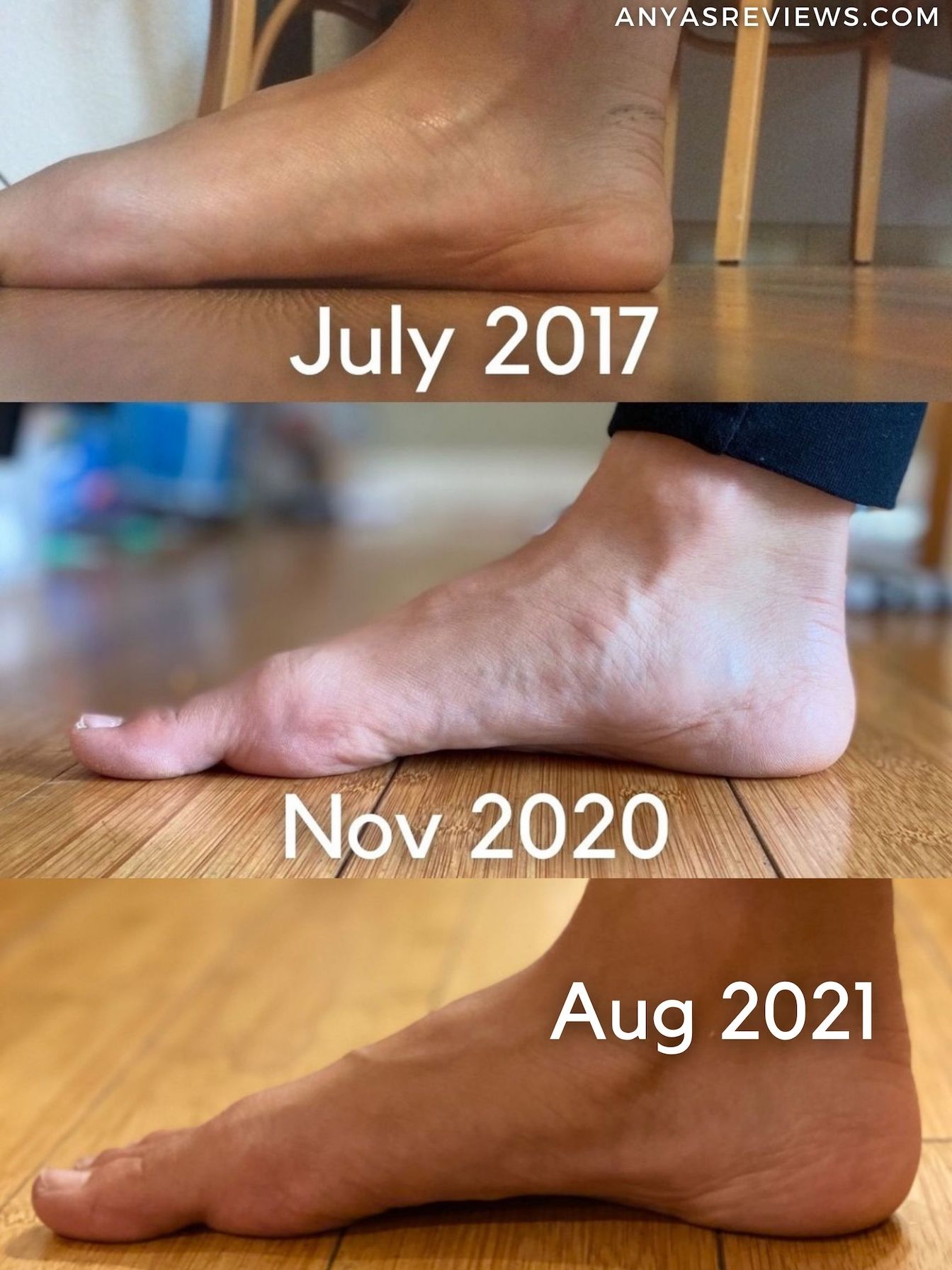 Why Birkenstocks Aren't a Long Term Solution to Foot Pain Anya's Reviews