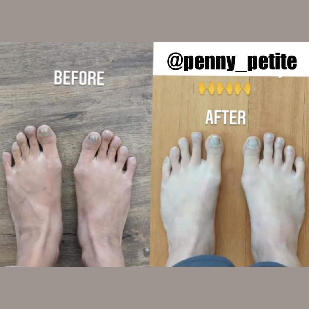 A bunion foot transformation using natural foot care, barefoot shoes, toe spacers, and foot exercises Penny Petite