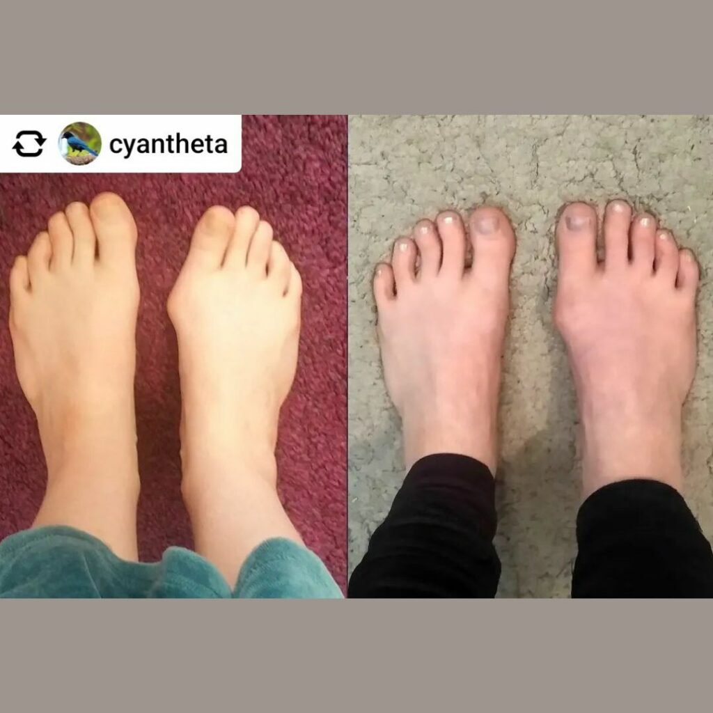 A bunion foot transformation using natural foot care, barefoot shoes, toe spacers, and foot exercises @cyantheta