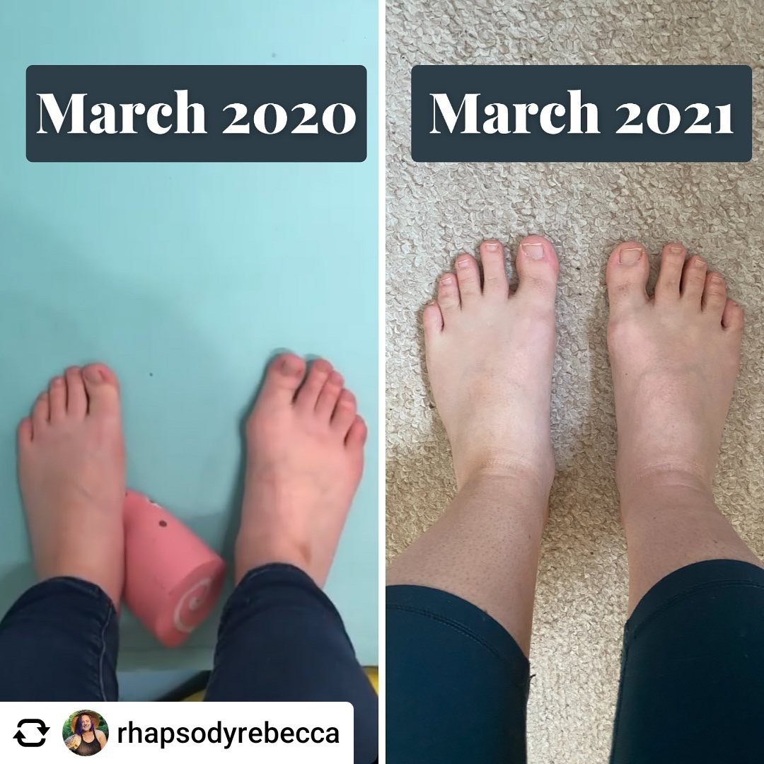 A bunion foot transformation using natural foot care, barefoot shoes, toe spacers, and foot exercises @rhapsodyrebecca