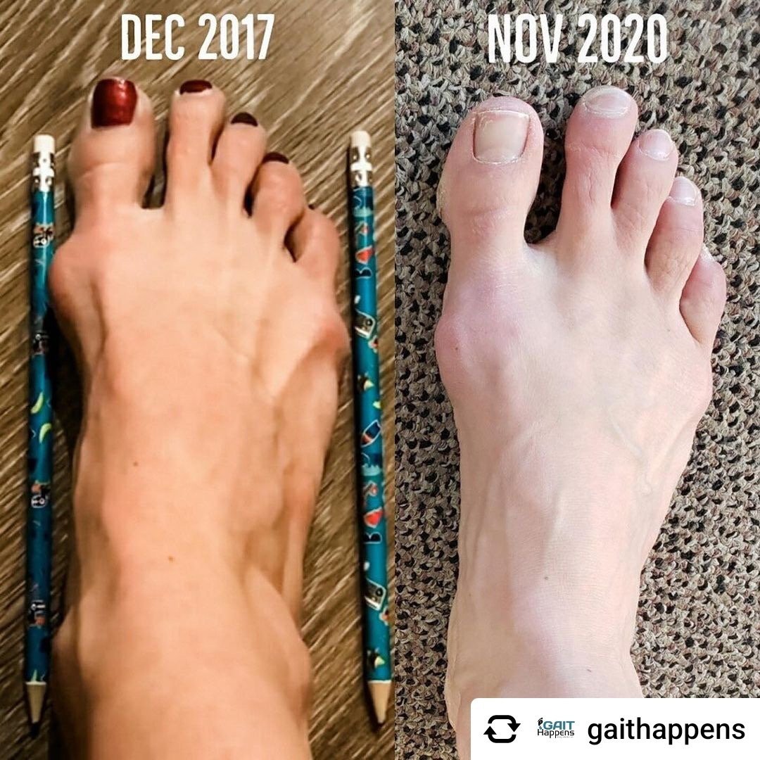 🔎 When it comes to #bunions , you probably know all too well how they can  hurt. But have you ever considered that #barefoot footwear might …