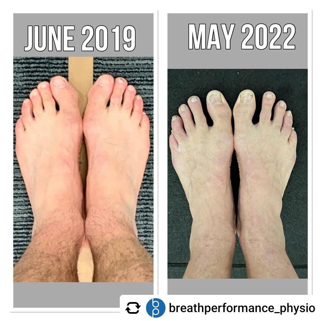 A bunion foot transformation using natural foot care, barefoot shoes, toe spacers, and foot exercises Breath Performance Physio