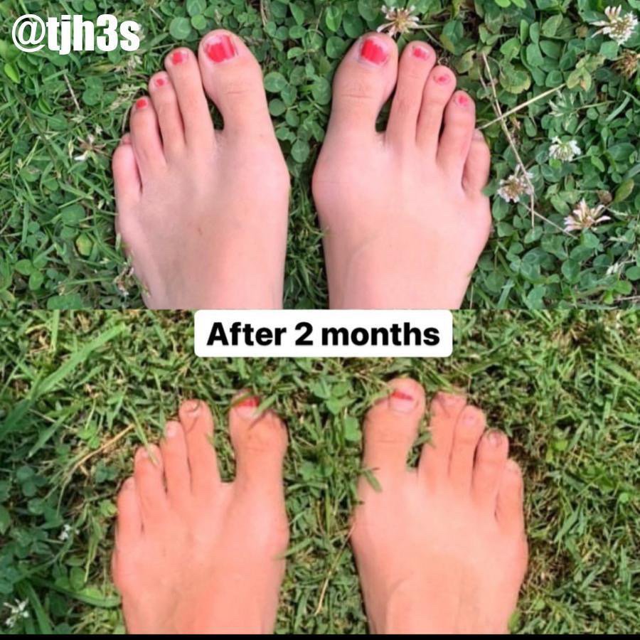 A bunion foot transformation using natural foot care, barefoot shoes, toe spacers, and foot exercises