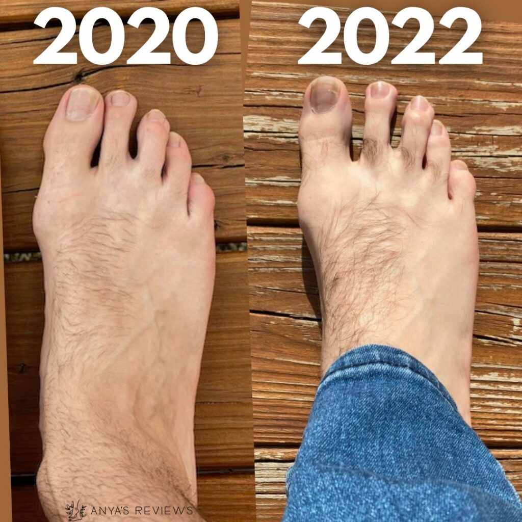 A bunion foot transformation using natural foot care, barefoot shoes, toe spacers, and foot exercises Justin