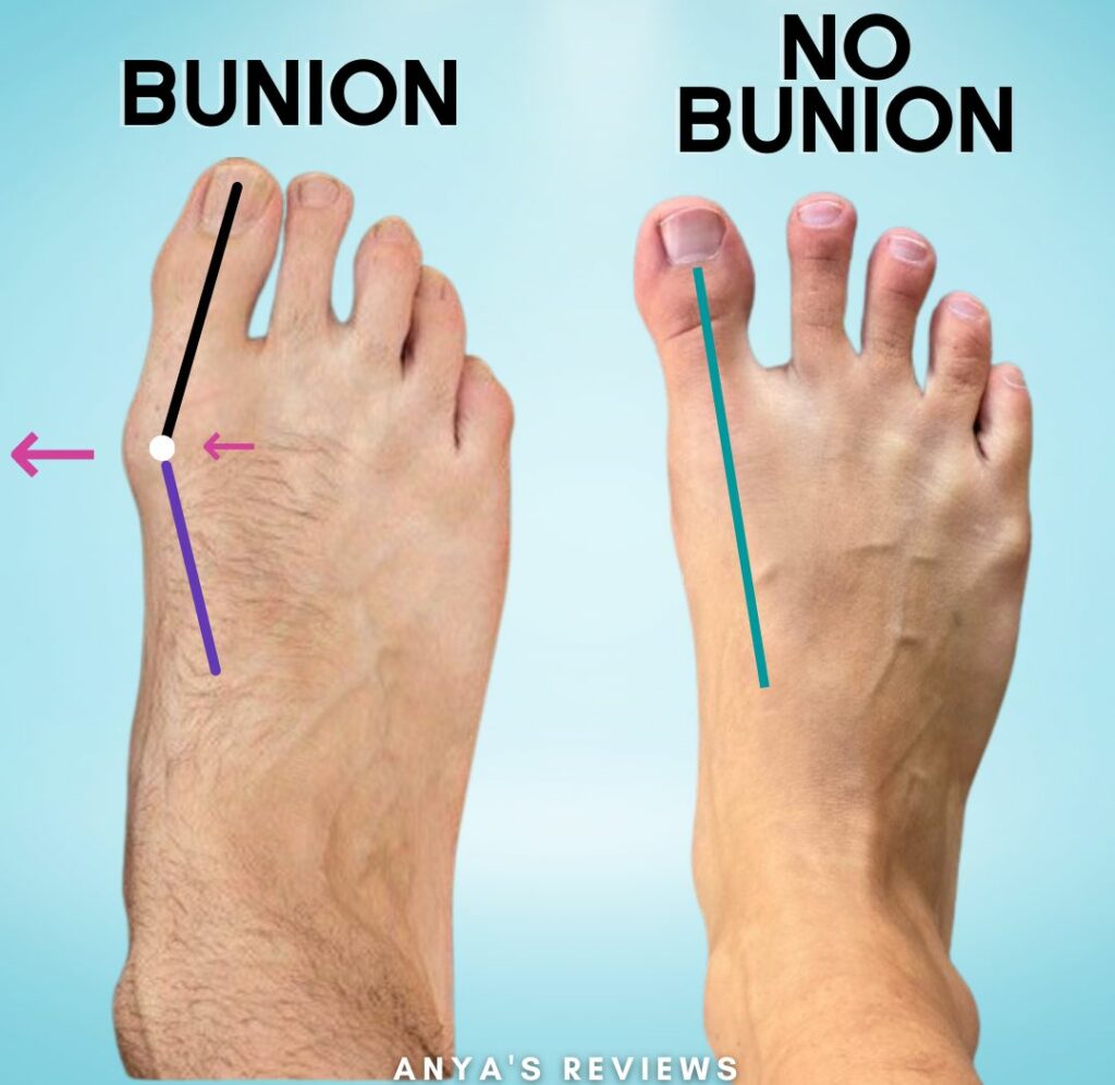 Bunion versus healthy foot demonstration copy e1667408122874