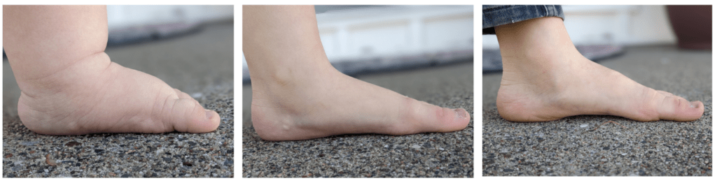 1 year old flat foot (left), 3 year old foot with arch becoming visible (middle), and 8 year old with formed arch (right)