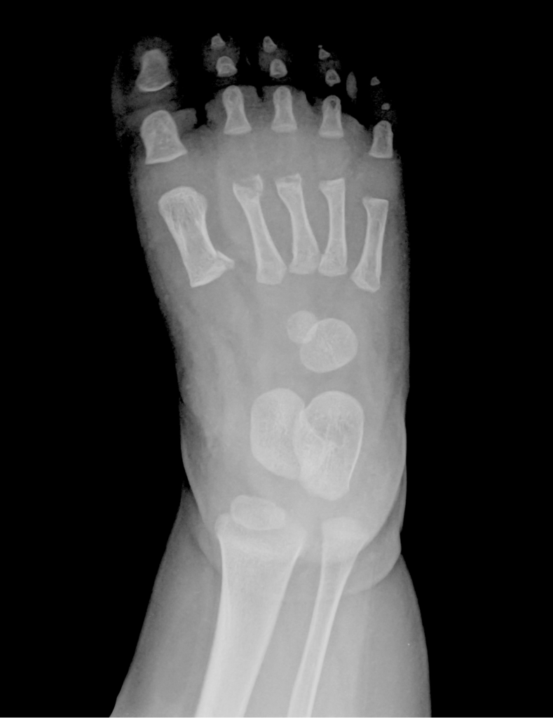 X ray of an infant's feet to show their bones unconnected and floating in foot fat